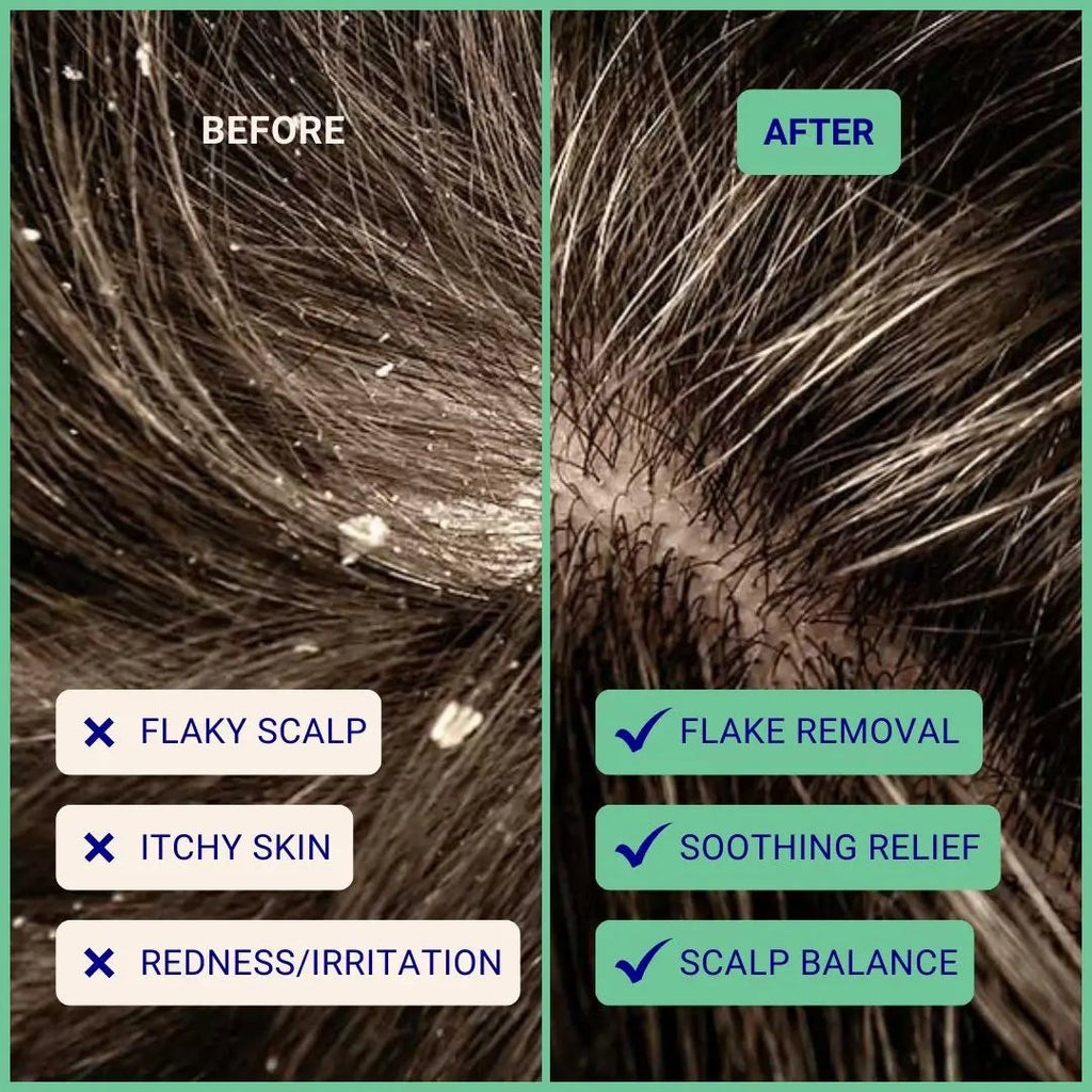 Exfoliating Shampoo For Loose Dandruff Flakes Tea Tree & Salicylic Acid 70g / 2.47oz